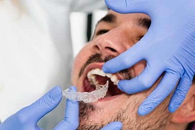 dentist placing a patient's new Invisalign clear aligners in his mouth