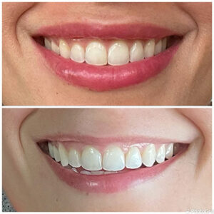 before and after photo of facial esthetics work at Cape Vista Dental