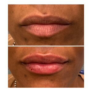 a before and after photo of facial esthetics work conducted at Cape Vista Dental
